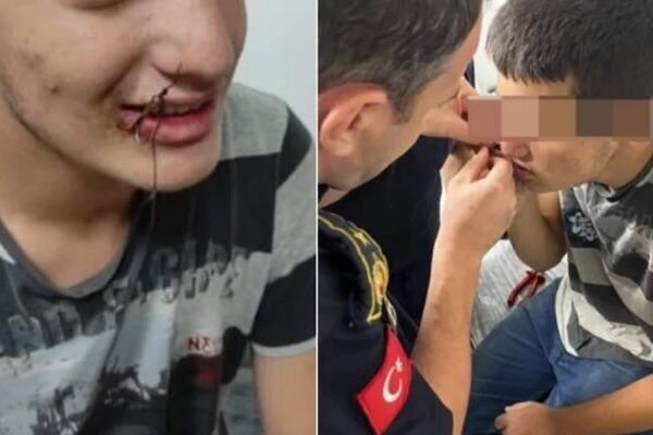 Ağzına balık oltası takılan çocuk, itfaiye ekiplerince kurtarıldı
